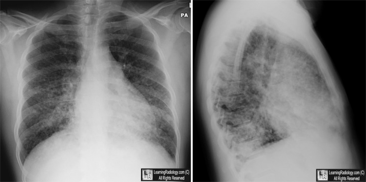 матовое стекло на кт при коронавирусе 80% поражения. матовое стекло на рентгене. симптом матового стекла в лёгких. симптом матового стекла в легких. интерстициальная пневмония кт матовое стекло.