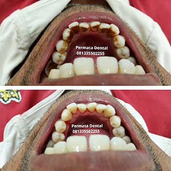 ahli gigi bali permata dental bersihkan karang gigi gigi kuning nikotin bekas rokok ahli gigi bali permata dental bersihkan karang gigi gigi kuning nikotin bekas rokok