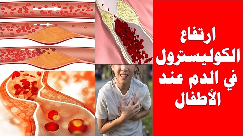 التغذية السليمة وارتفاع الكوليسترول في الدم عند الأطفال التغذية السليمة وارتفاع الكوليسترول في الدم عند الأطفال,Good nutrition and high cholesterol in children