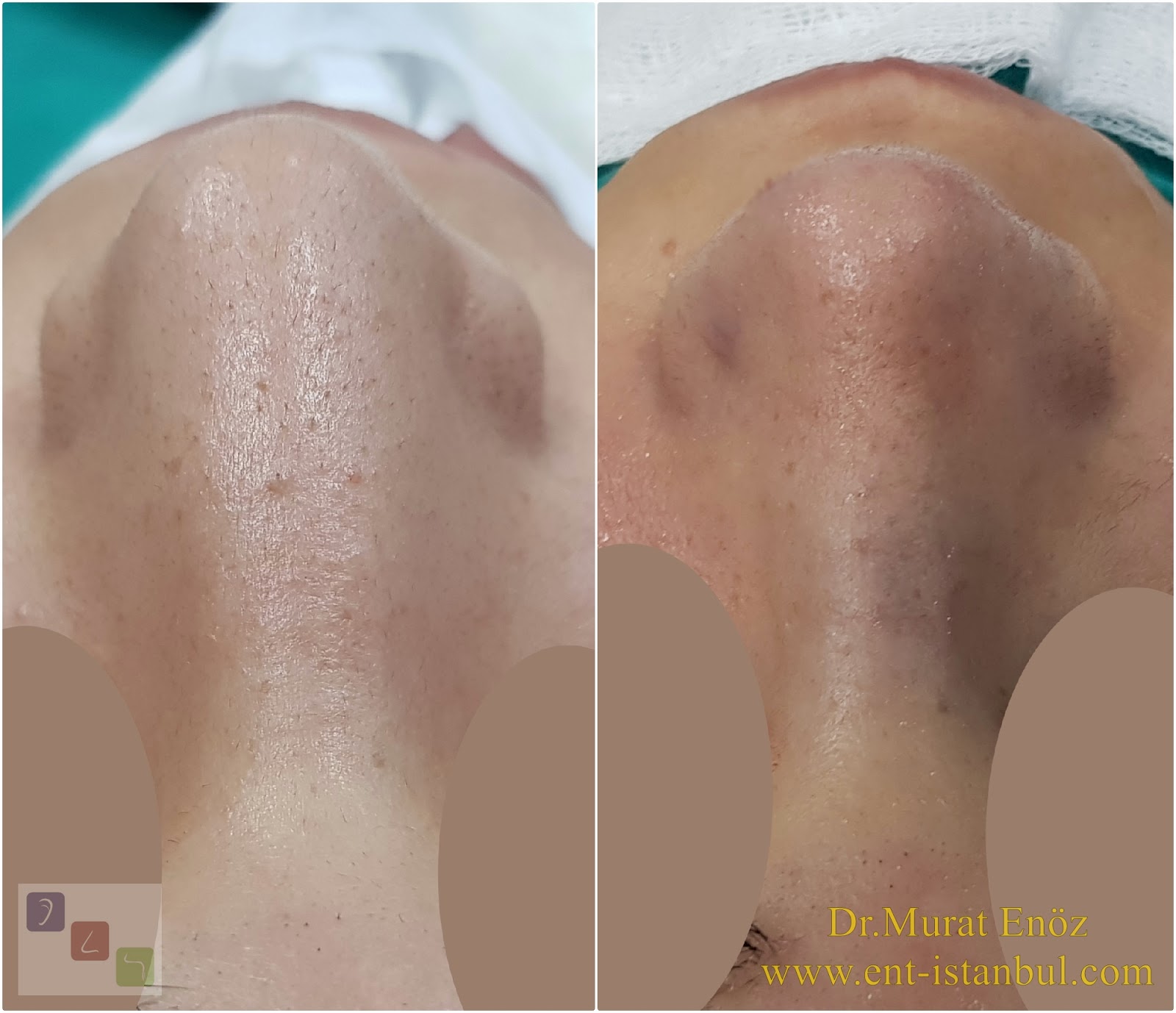We Performed Again Thick Skin Revision Rhinoplasty Operation!