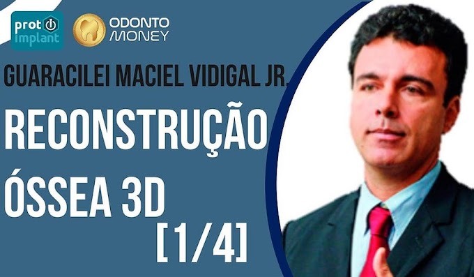 IMPLANTODONTIA: Reconstrução Óssea 3D para Implantes Dentários (Video 1)