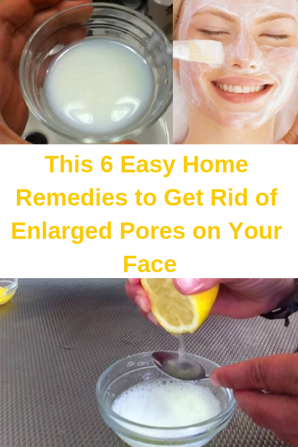 This 6 Easy Home Remedies to Get Rid of Enlarged Pores on Your Face healhty and tips