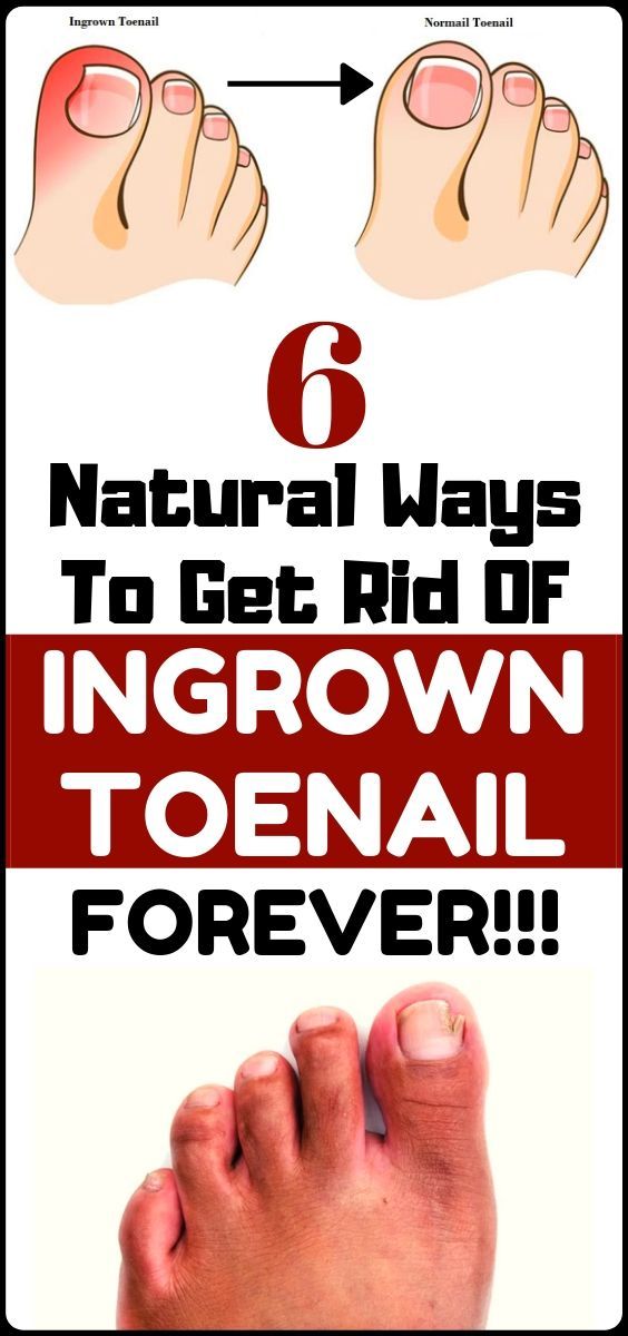 Treat Your Ingrown Toenail With These 6 Natural & Homemade Remedies