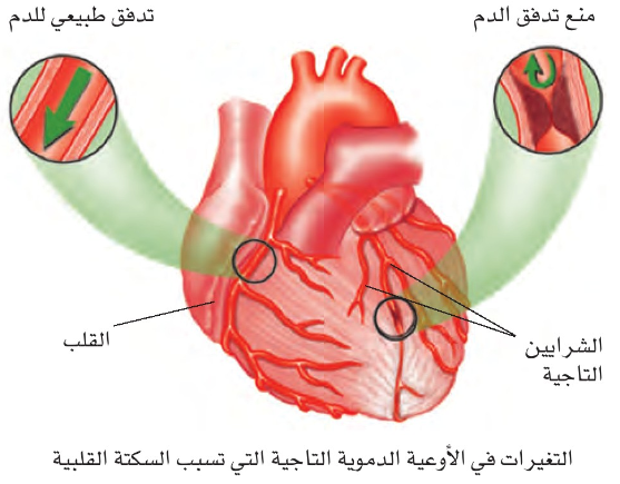 التغيرات في الأوعية الدموية التاجية التي تسبب السكتة القلبية