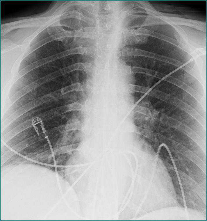 Name seven causes of an elevated hemidiaphragm. What is the workup