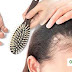 How control hair fall and hair dandruff naturally. Prohairstyletrends