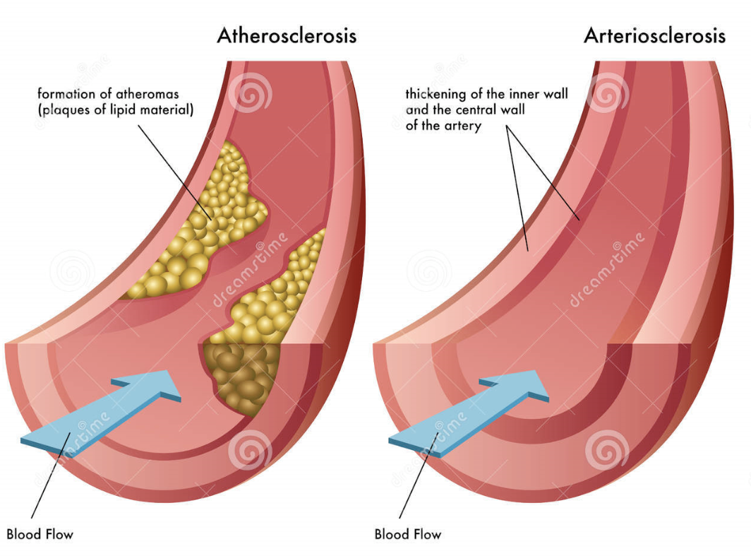 Existe diferença entre aterosclerose e arteriosclerose? RR Nutrição Clínica