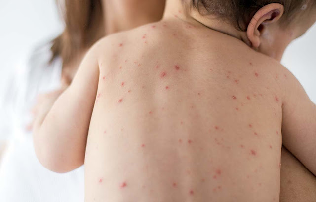 Oito novos casos de sarampo são registrados em Jacobina e Santo Amaro