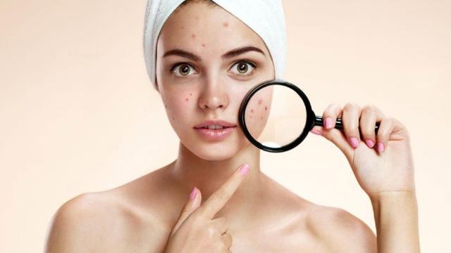menyembuhkan jerawat