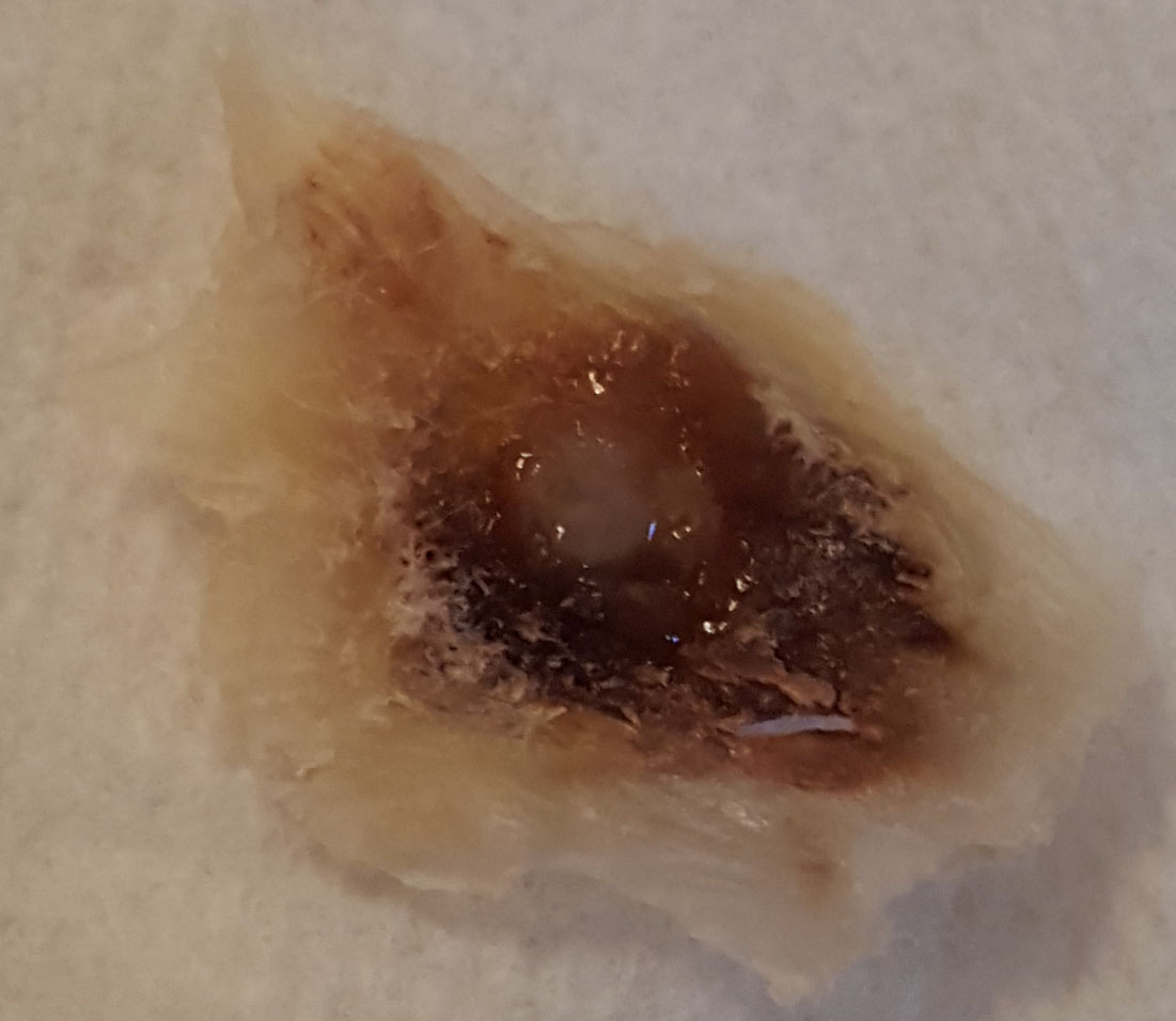 My Plantar Wart Treatment Experience My plantar wart treatment