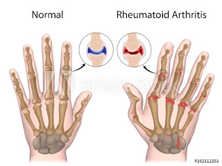 Rheumatism Arthritis
