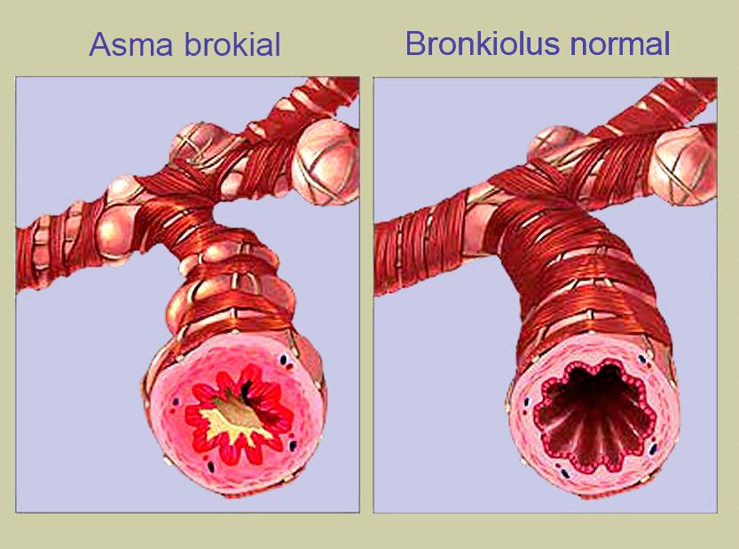 Asma Bronchitis