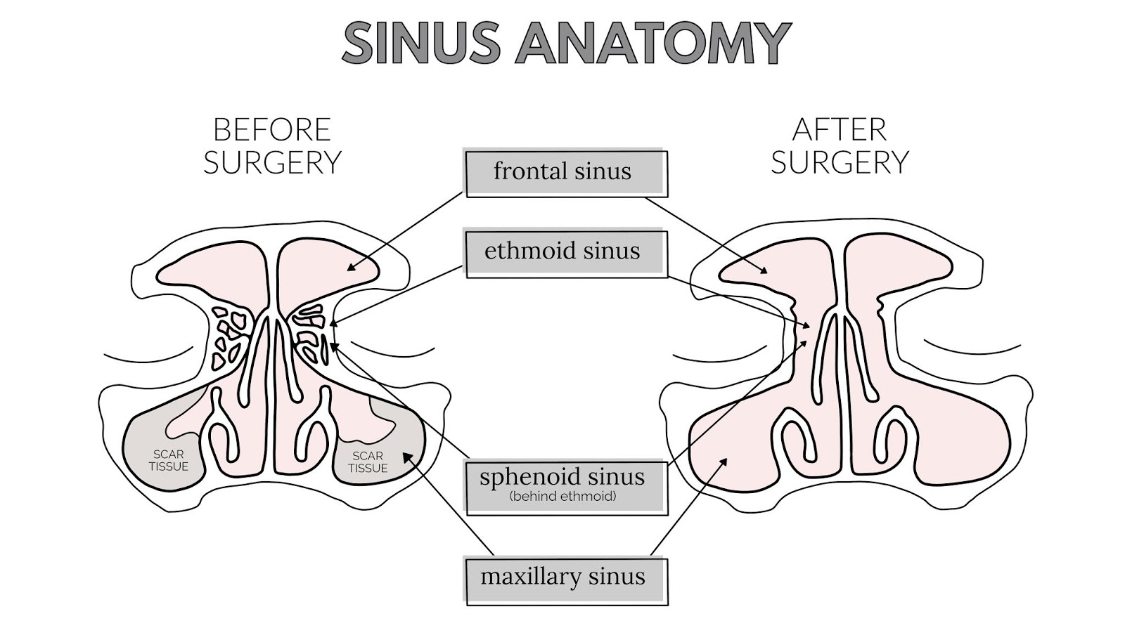 Jordan Hebl The Truth About Sinus Surgery My Experience