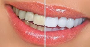 Tips Memutihkan Gigi Secara Alami 