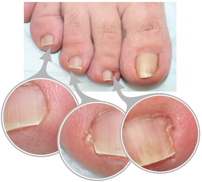 How to Get Rid of a Painful Ingrown Toenail as Fast as Possible Without
