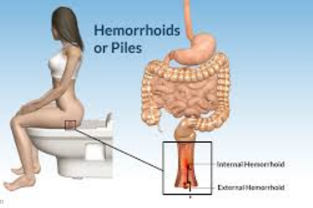 pengobatan hemoroid 