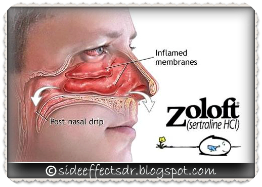 are zoloft side effects temporary