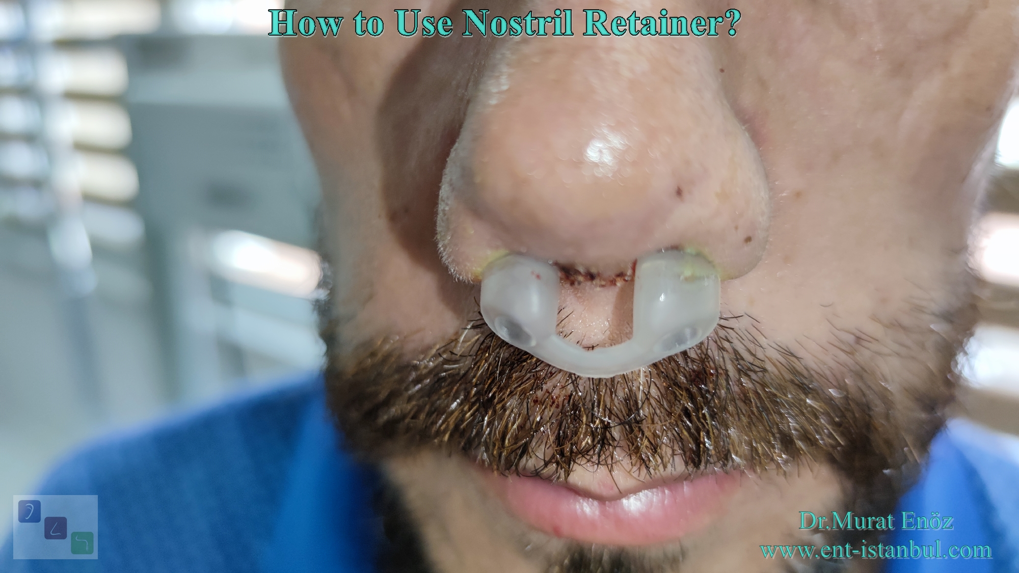 About The Nostril Retainer