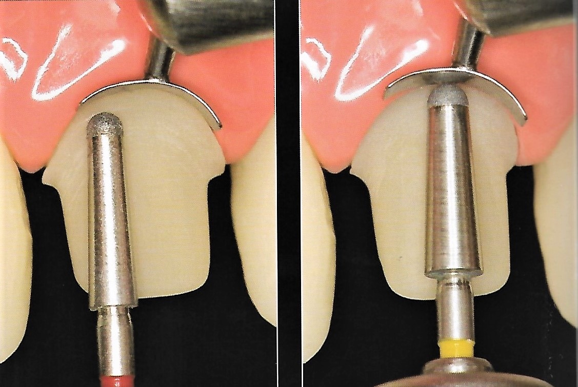 Anterior Crown Preparation Dental Esthetics