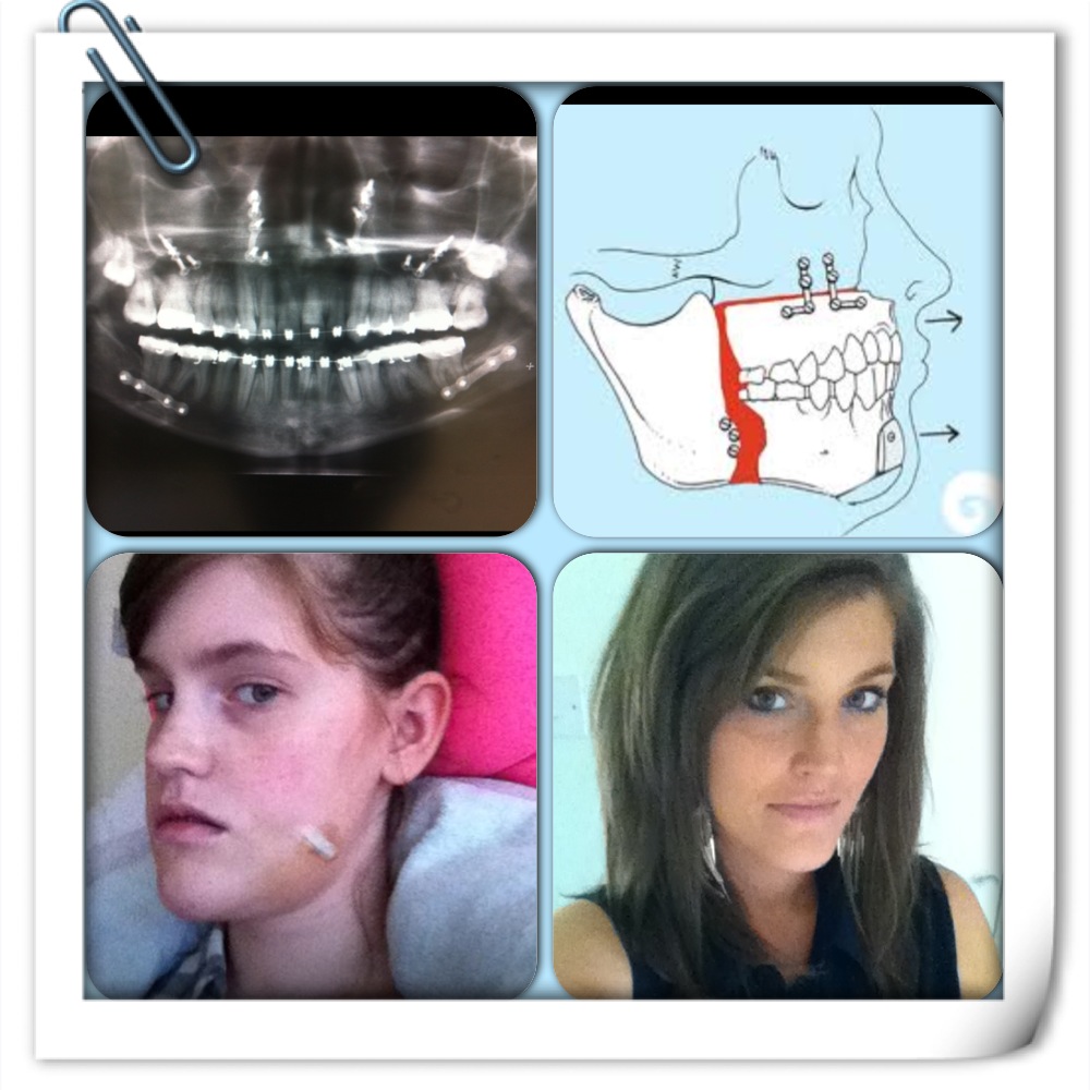 A Guide to Surviving Orthognathic Surgery: Q&A Jaw Surgery