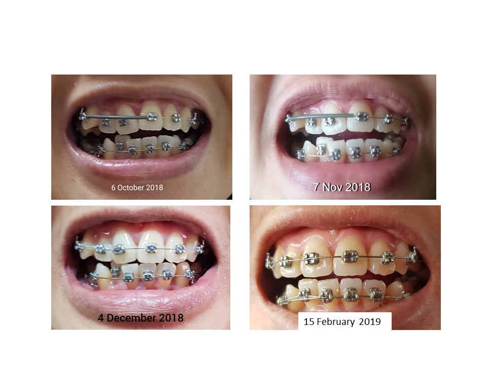 nanyfadhly Braces Story Updated! Part 5