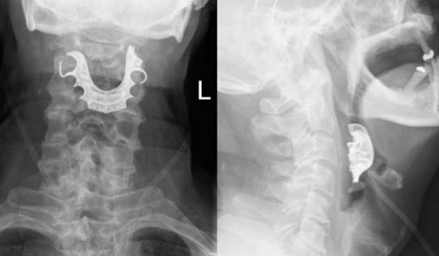 Após cirurgia, paciente tem rouquidão e dor ao engolir; dentadura estava na garganta