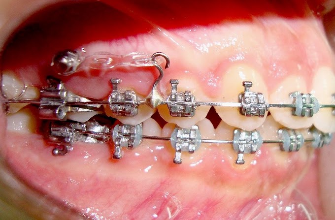 ORTODONTIA: Instalação de Mini Implante para distalização de molar