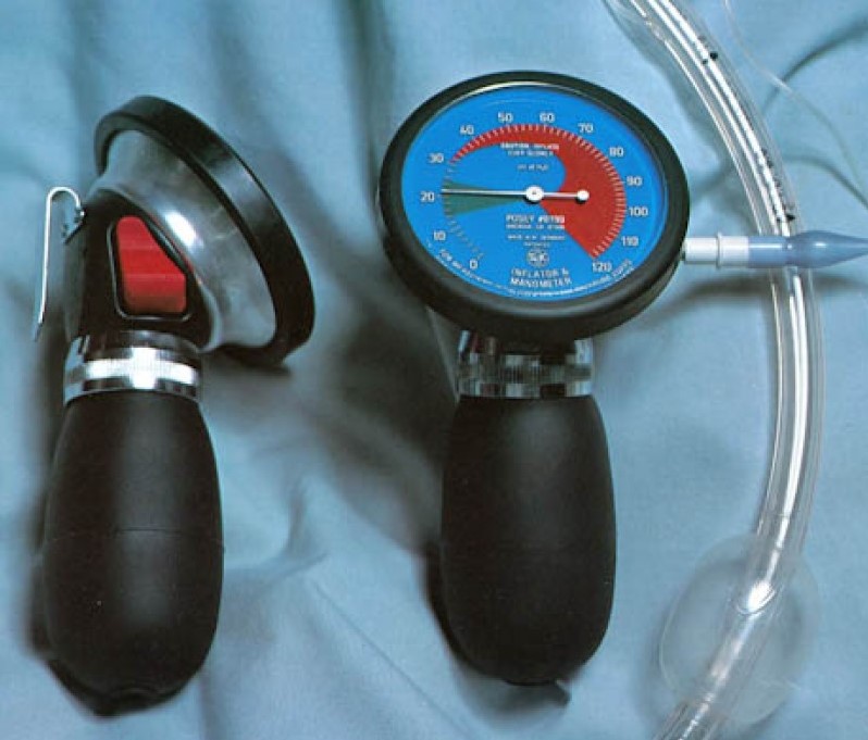 Methods to stabilize ETT intracuff pressure Anesthesia Morbidity and
