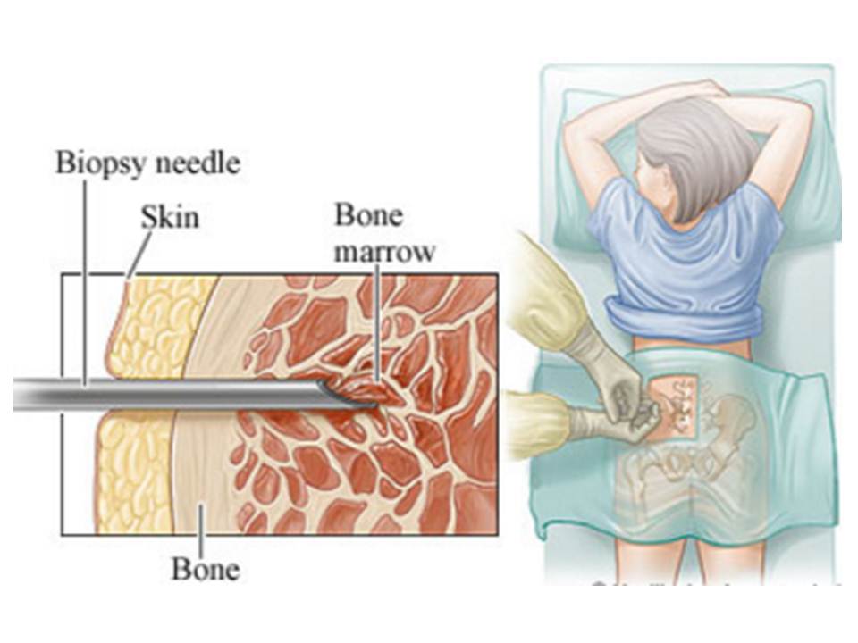 The Problem with MDS: Everything You Wanted To Know About A Bone Marrow