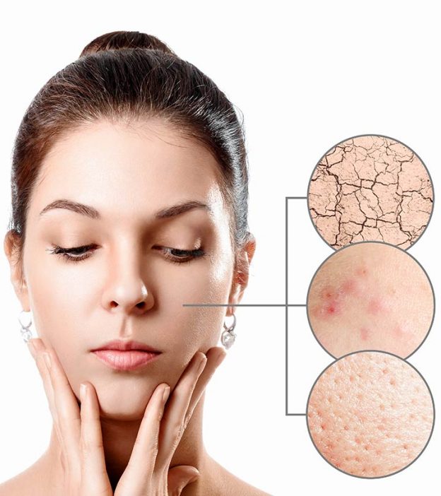 How To Resolve Breakout Without Drying Out Your Skin?
