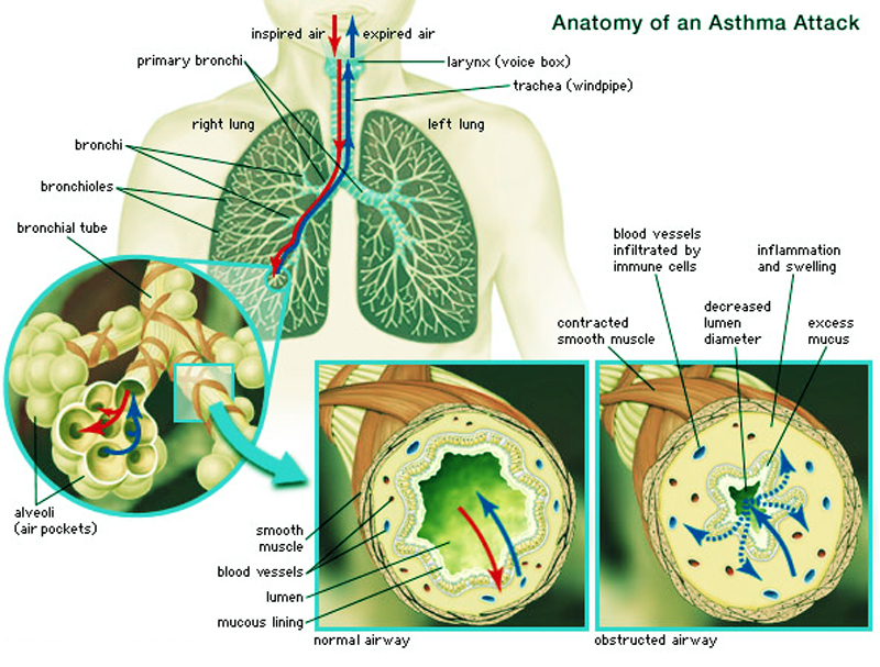 Pathophysiology Asthma Airway