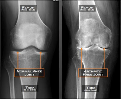knee pain treatment best orthopedic doctor in Paranaque