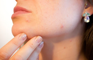 Adult Acne On Chin