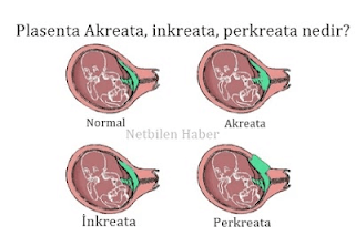 plasenta inkreata perkreata