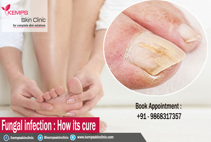 What Is Fungal Infection And How Its Cure KEMPS Skin Clinic what-is-fungal-infection-and-how-its-cure-kemps-skin-clinic