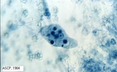 Entamoeba ginggivalis Entamoeba ginggivalis