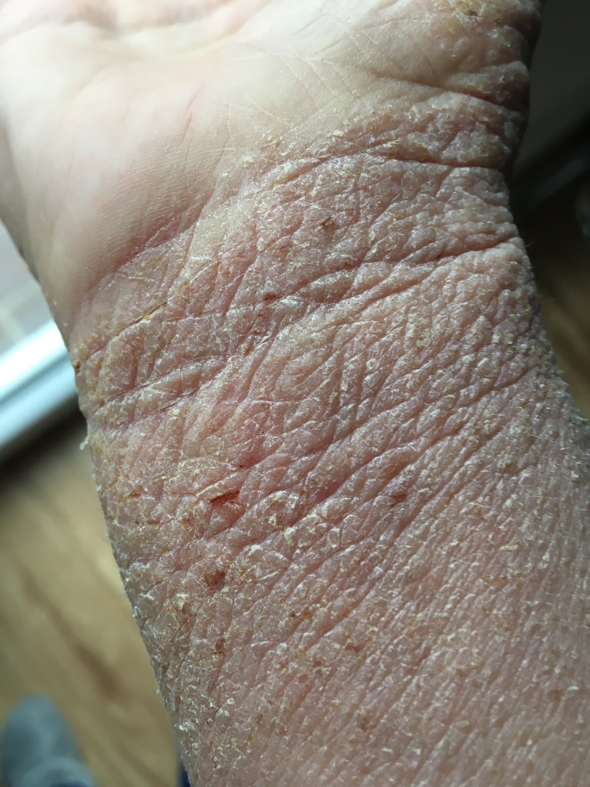 Snowing In May Razlika med atopijskim dermatitisom in sindromom rdeče kože