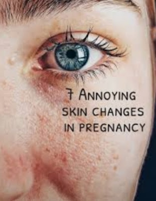 https://magda-world-spisane.blogspot.com/2021/09/Acne-And-Skin%20-Changes-In-Pregnancy.html?m=1