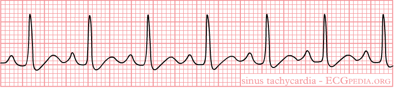 Ekg Sinus Tasikardi Svt Atriyal Flutter Atriyal Fibrilasyon