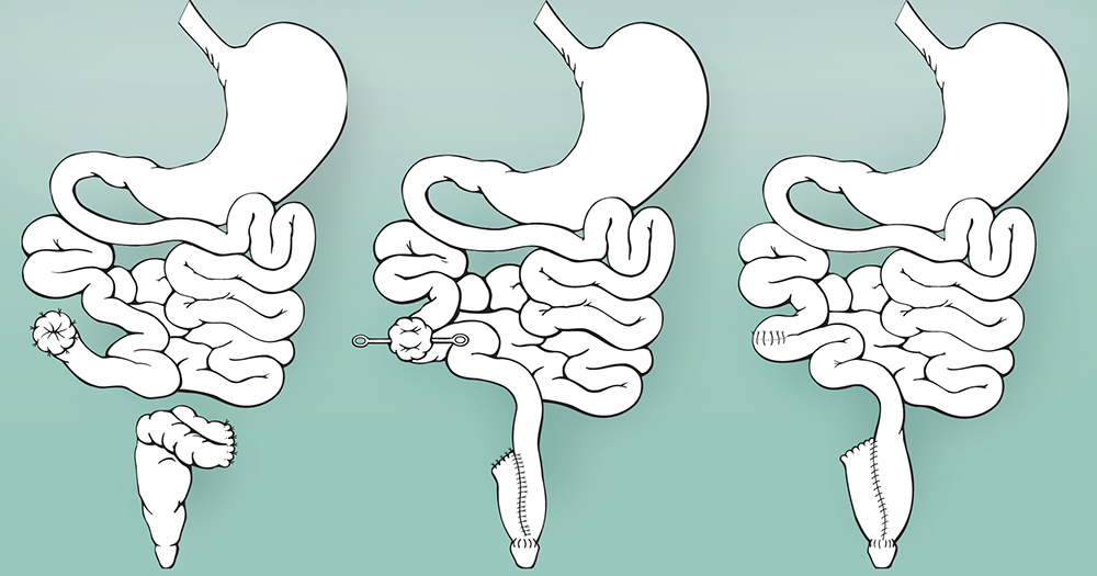 Gastric Health Blog Different Types Of Colectomy Surgery