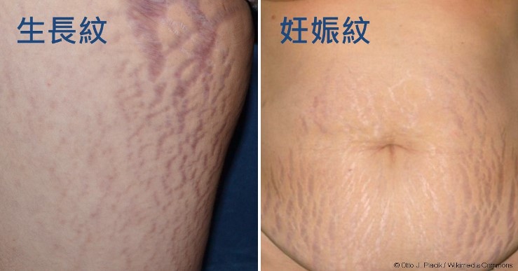 妊娠紋、肥胖紋除得掉嗎?能夠預防嗎?照護線上