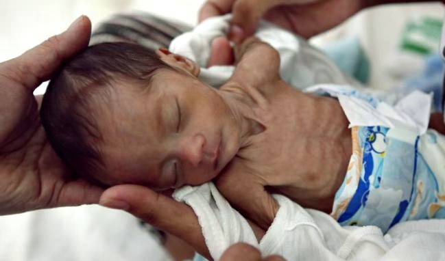 Masalah Gizi Buruk (Berita dan Resume) - agribisnis