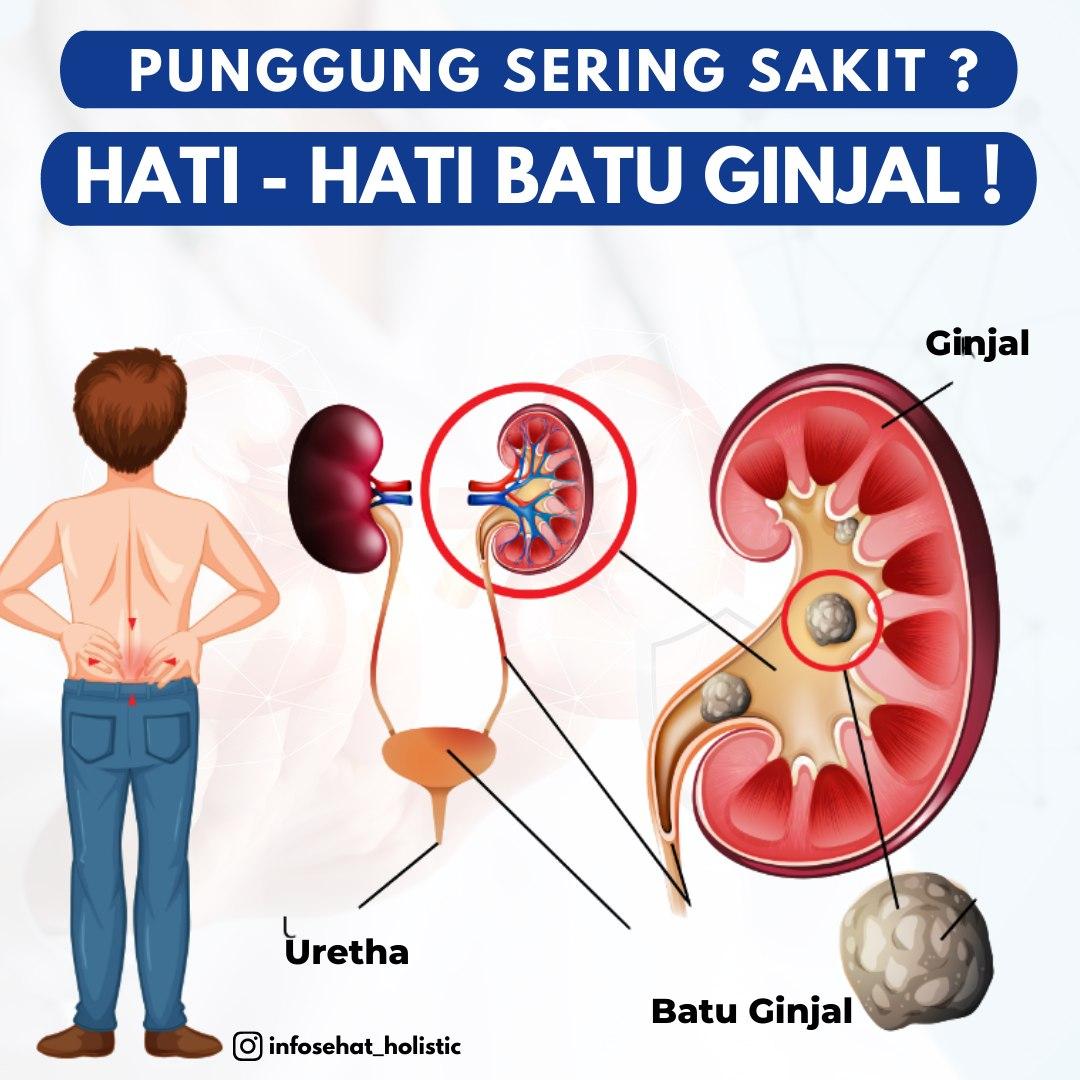 APA ITU BATU GINJAL? MARI KITA BAHAS BERSAMA! - Maryam Herbal