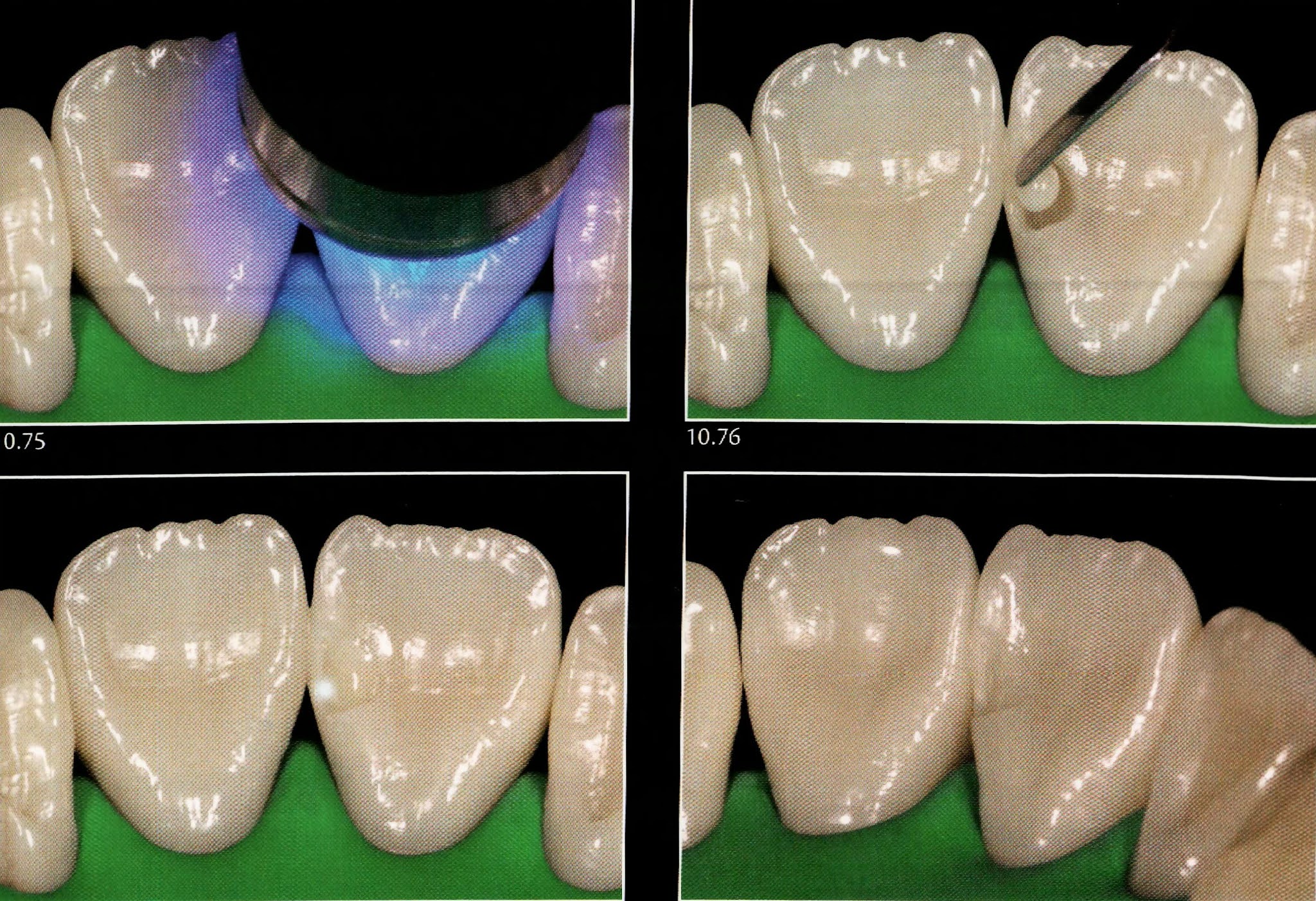 Class III composite restoration " Palatal access " Dental Esthetics