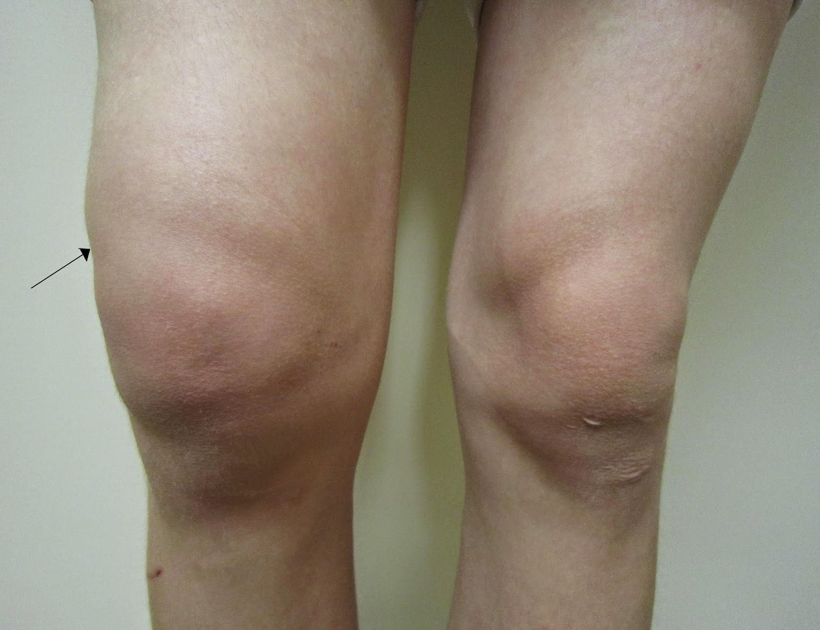 4-simple-tips-to-avoid-knee-pain-after-running-house-of-tasty