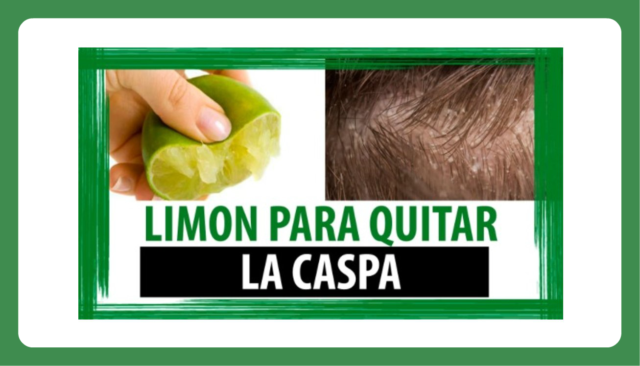 Video Como quitar la caspa con limón Natwiki