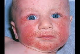 Seborrheic Dermatitis - familydoctor.org