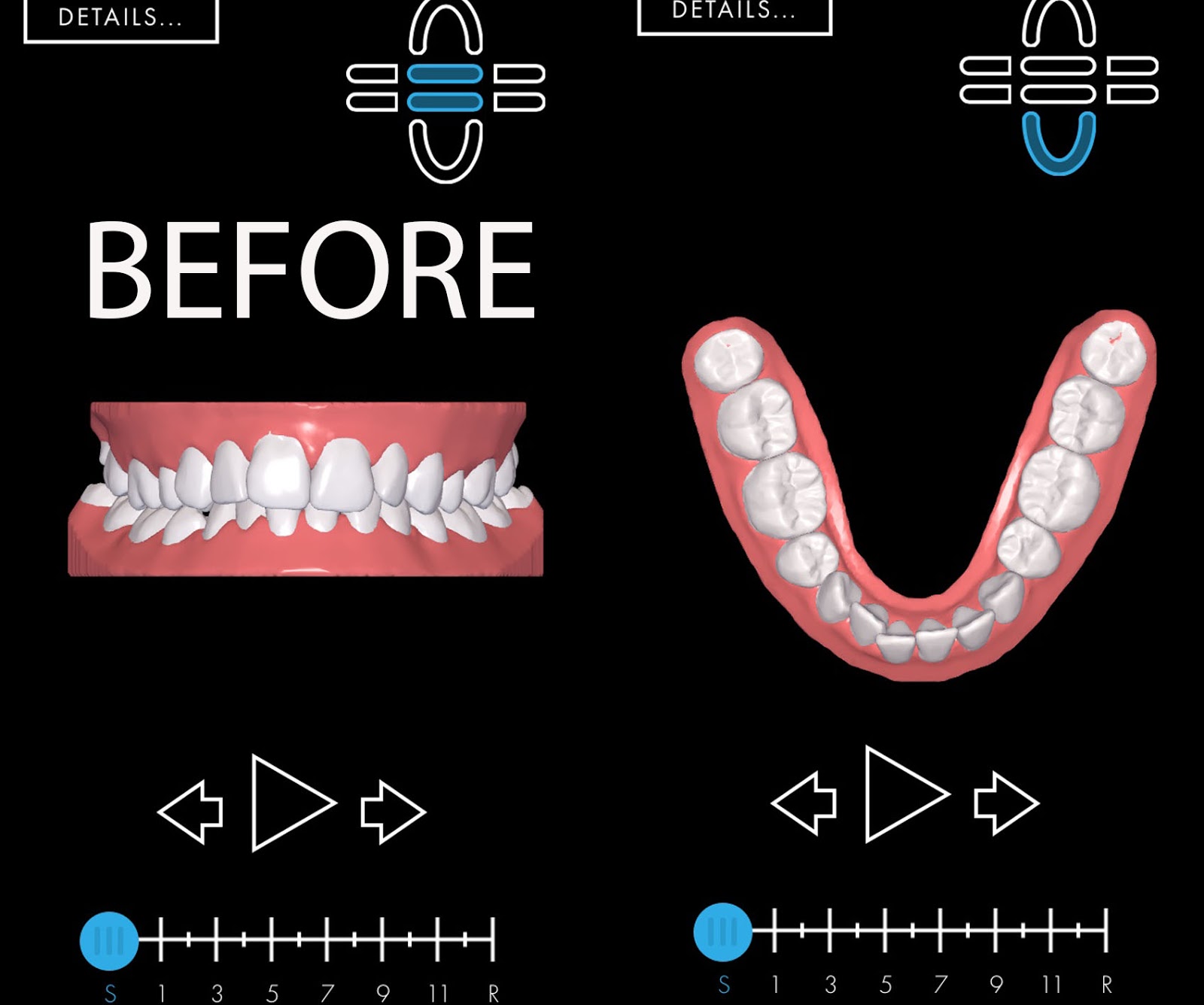 INVISABLE BRACES \\ WITH YOUR SMILE DIRECT GIRL TALK WITH LAURA