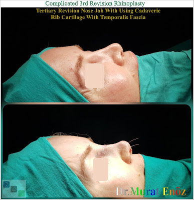 Complicated 3rd Revision Rhinoplasty  Tertiary Revision Nose Job With Using Cadaveric Rib Cartilage With Temporalis Fascia