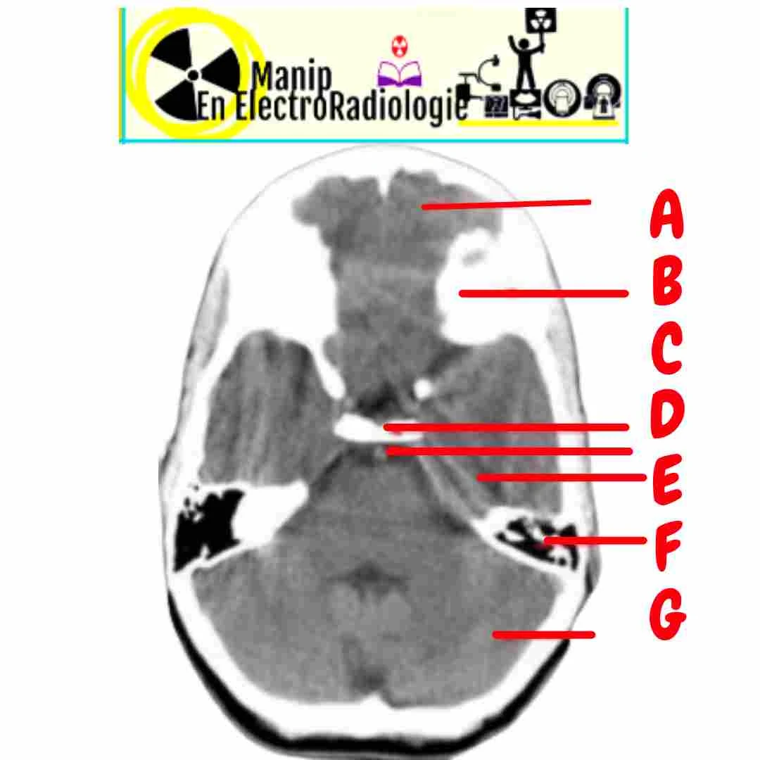 Structures anatomiques du tdm cérébral normal au niveau de la selle turcique